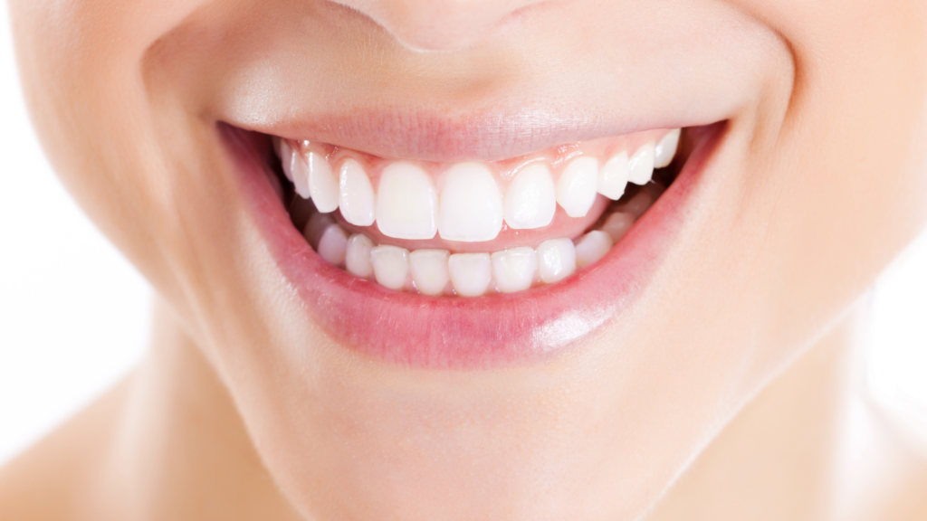 Dental veneers smile