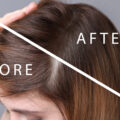 A woman's head showing before and after hair loss treatment