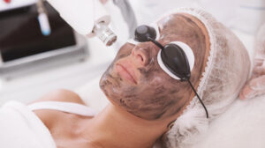 Laser Treatment for Different Acne Types: What Works Best Where Laser Treatment for Different Acne Types: What Works Best Where